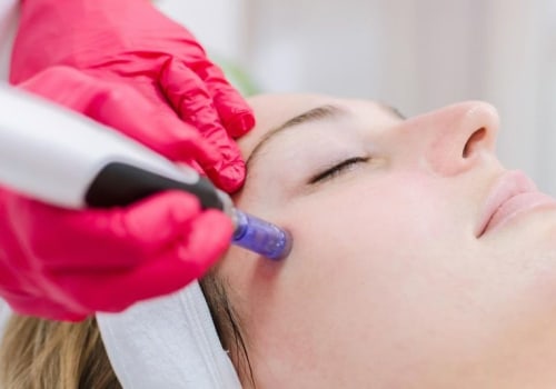 From Fitness Gym Gains To Skin Gains: The Power Of Collagen Induction Therapy Microneedling